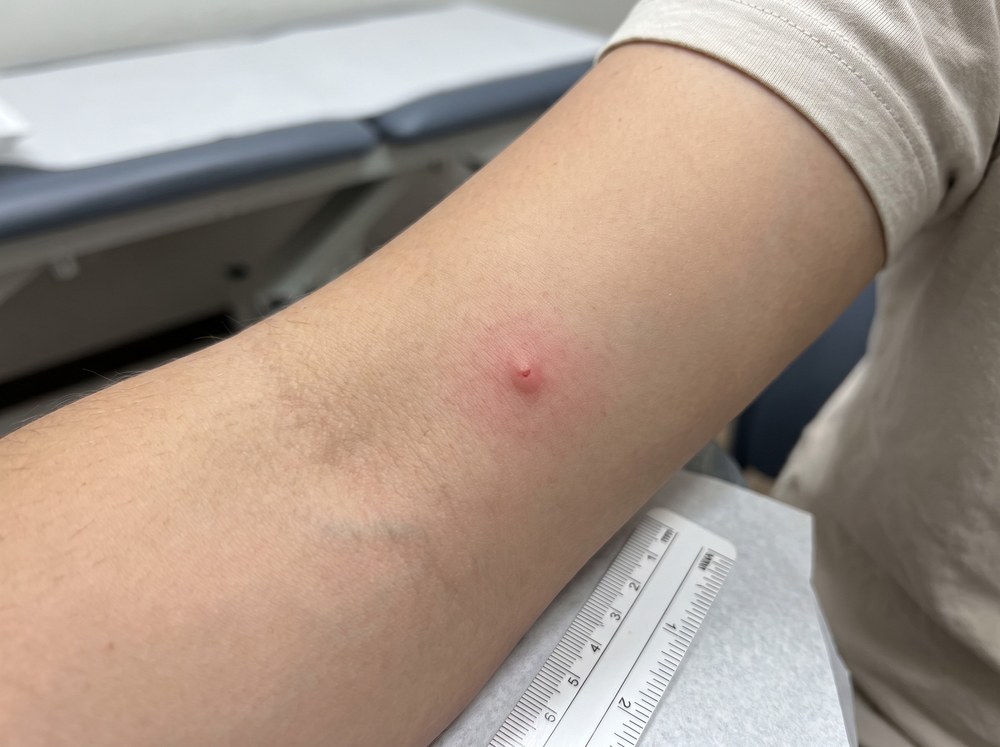 Close-up of a small red itchy mosquito-type bite bump on skin, the kind often mistaken for a crane fly bite